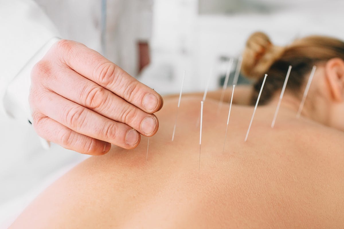 Akupunktur zur Geburtsvorbereitung
